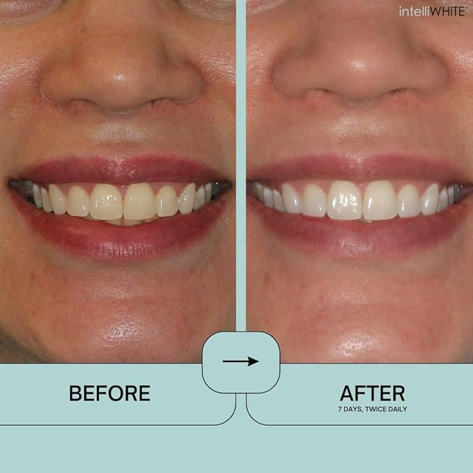 Prostrips - 12 Shades Whiter Teeth - 28 Enamel Safe REMINERALIZING Gentle Strips ??97% no Sensitivity