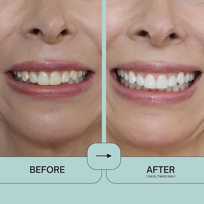 Prostrips - 12 Shades Whiter Teeth - 28 Enamel Safe REMINERALIZING Gentle Strips ??97% no Sensitivity