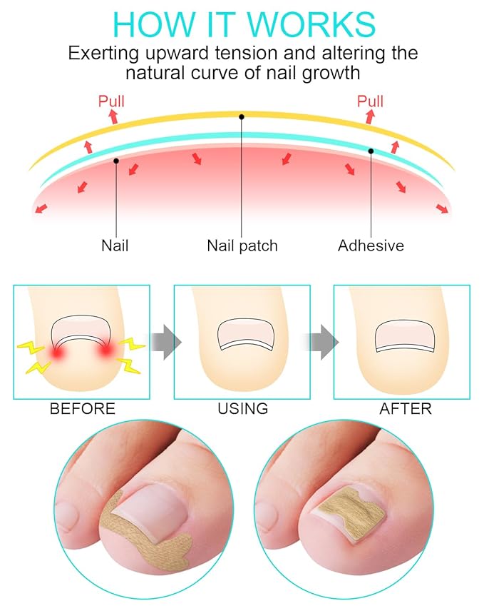 Ingrown Toenail Correction Treatment Tool, 60Pcs Ingrown Toe nail Corrector Patch in 2 Types, Professional Safe Ingrown Toenail Tool with 2 Pedicure Tools for Ingrown Toenail Remover