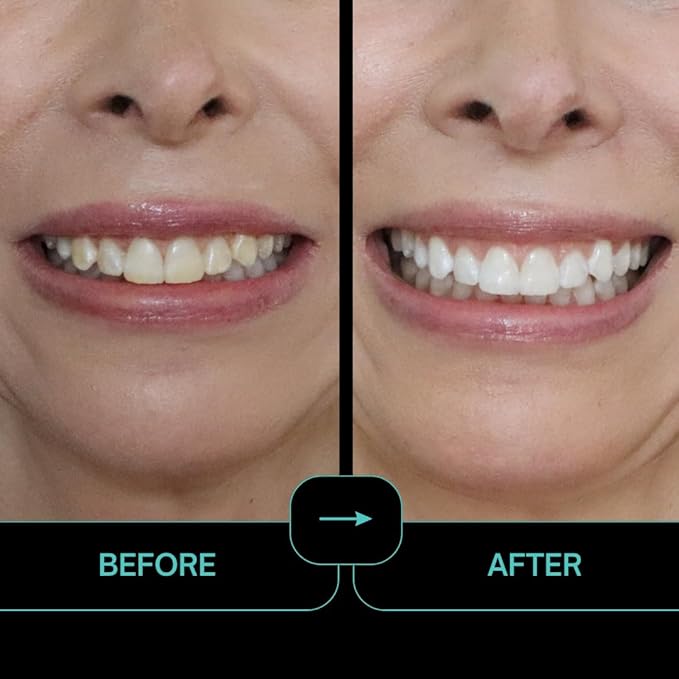 Prostrips - 12 Shades Whiter Teeth - 56 Enamel Safe REMINERALIZING Gentle Strips ??97% Had No Sensitivity - Bonus Size