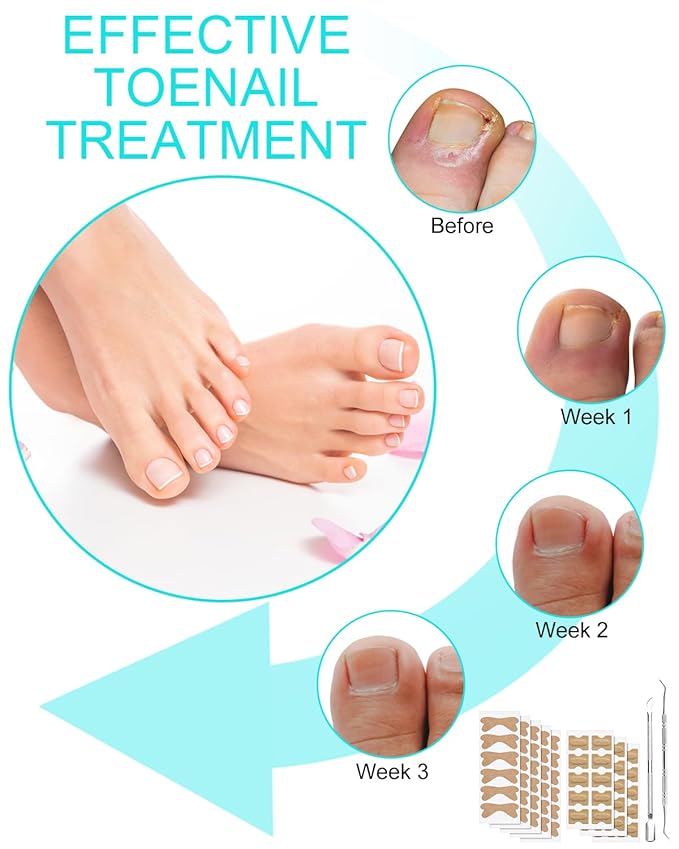 Ingrown Toenail Correction Treatment Tool, 60Pcs Ingrown Toe nail Corrector Patch in 2 Types, Professional Safe Ingrown Toenail Tool with 2 Pedicure Tools for Ingrown Toenail Remover