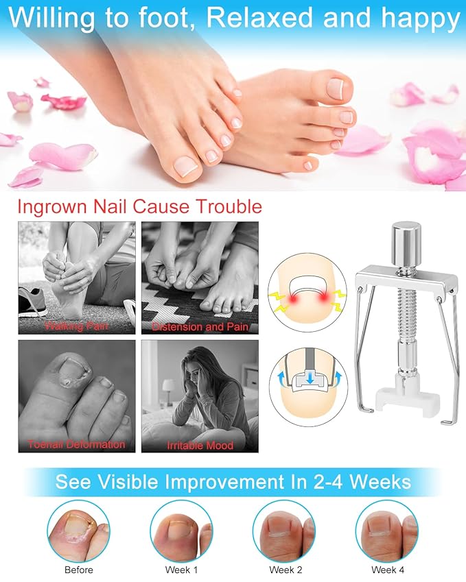 Ingrown Toenail Removal Kit, Ingrown Toenail Treatment, Ingrown Toenail Corrector Tools Come with Podiatry Toenail Braces, Ingrown Toenail Corrector Strips and Patch for Toe Pain Relief