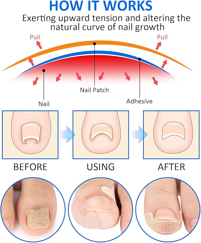 Ingrown Toenail Correction Treatment Tool, 64Pcs Breathable Ingrown Toenail Strips in 3 Types, No Glue Safe Ingrown Toenail Tool with 2 Pedicure Tools for Ingrown Toenail Remover