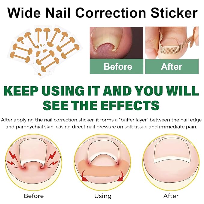 Ingrown Toenail Corrector Set with Correction Strips, Professional Ingrown Toenails Pedicure Tool Set, Painless File and Lifter Pedicure Tools Pedicure Tools, Ingrown Nail Tool for Women Man