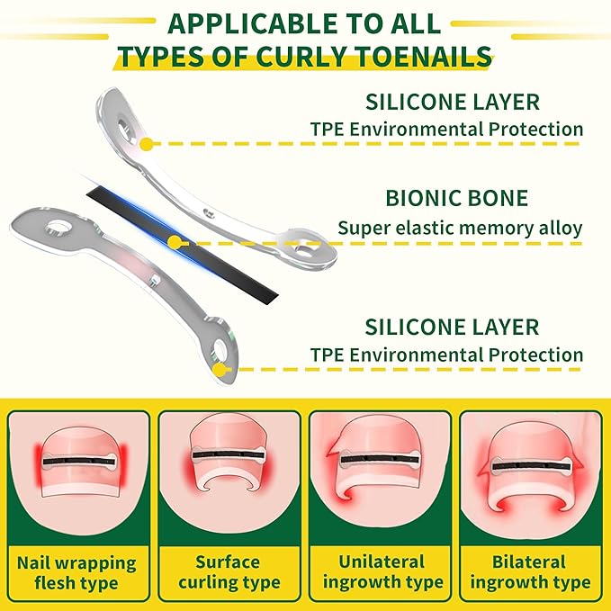 Large Size-Titanium Alloy Ingrown Toenail Treatment & Removal Kit for Quick Relief, Ingrown Toenail Removal Kit竊?Professional Ingrown Toenail Corrector, Ingrown Toenail Tools for Quick Relief, 10 Pcs