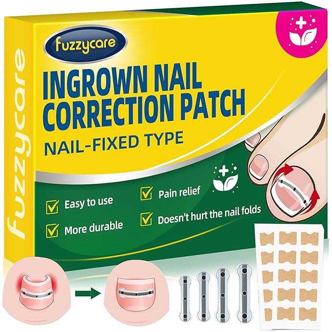 Large Size-Titanium Alloy Ingrown Toenail Treatment & Removal Kit for Quick Relief, Ingrown Toenail Removal Kit竊?Professional Ingrown Toenail Corrector, Ingrown Toenail Tools for Quick Relief, 10 Pcs