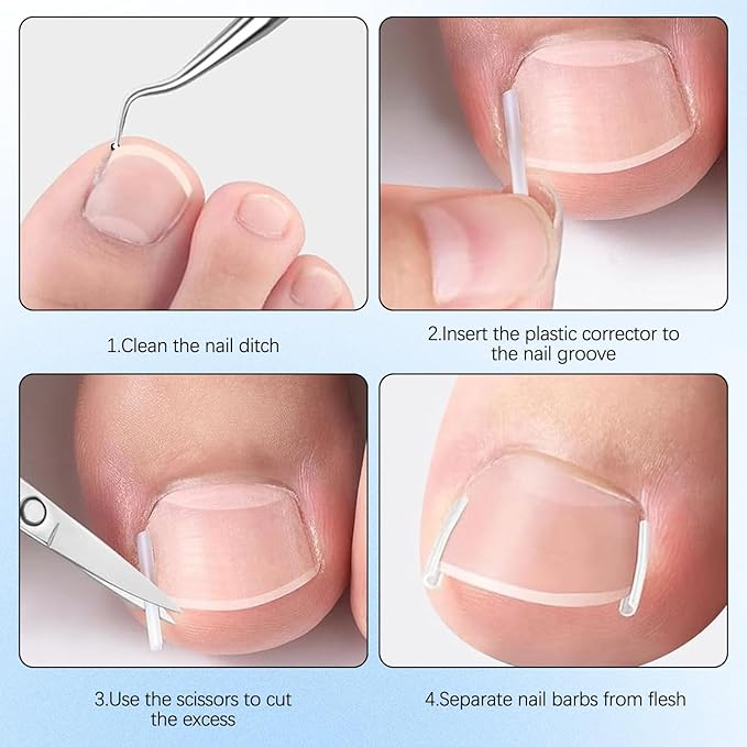 Professional Ingrown Toenail Set with Breathable Ingrown Toenail Strips, Curved Toenails Corrector Patch, Painless File and Lifter Pedicure Tools