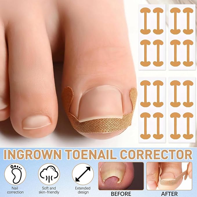 Ingrown Toenail Corrector Set with Breathable Toenail Strips, Curved Nail Corrector Patch, File and Lifter, Professional Pedicure Tools for Men and Women, Easy At-Home Toenail Care Kit