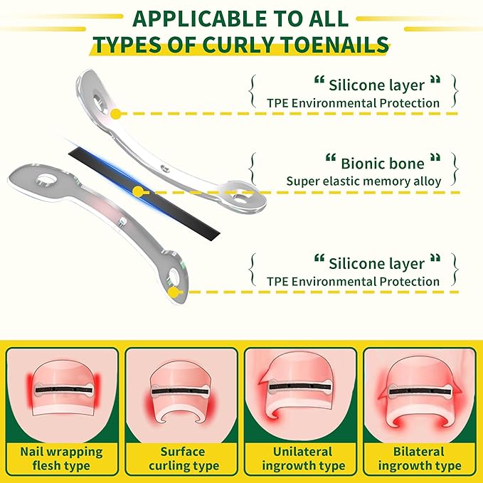 Small Size-Titanium Alloy Ingrown Toenail Treatment & Removal Kit for Quick Relief, Ingrown Toenail Removal Kit竊?Professional Ingrown Toenail Corrector, Ingrown Toenail Tools for Quick Relief, 10 Pcs