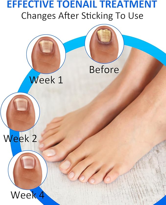 Ingrown Toenail Correction Treatment Tool, 64Pcs Breathable Ingrown Toenail Strips in 3 Types, No Glue Safe Ingrown Toenail Tool with 2 Pedicure Tools for Ingrown Toenail Remover
