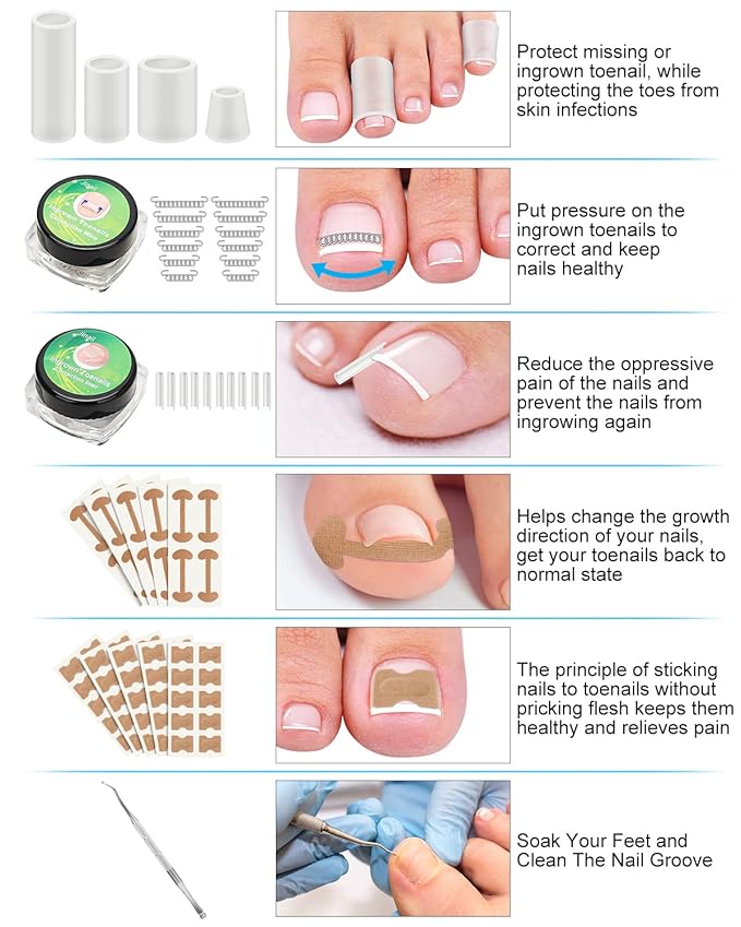 Ingrown Toenail Removal Kit, Ingrown Toenail Treatment, Ingrown Toenail Corrector Tools Come with Podiatry Toenail Braces, Ingrown Toenail Corrector Strips and Patch for Toe Pain Relief
