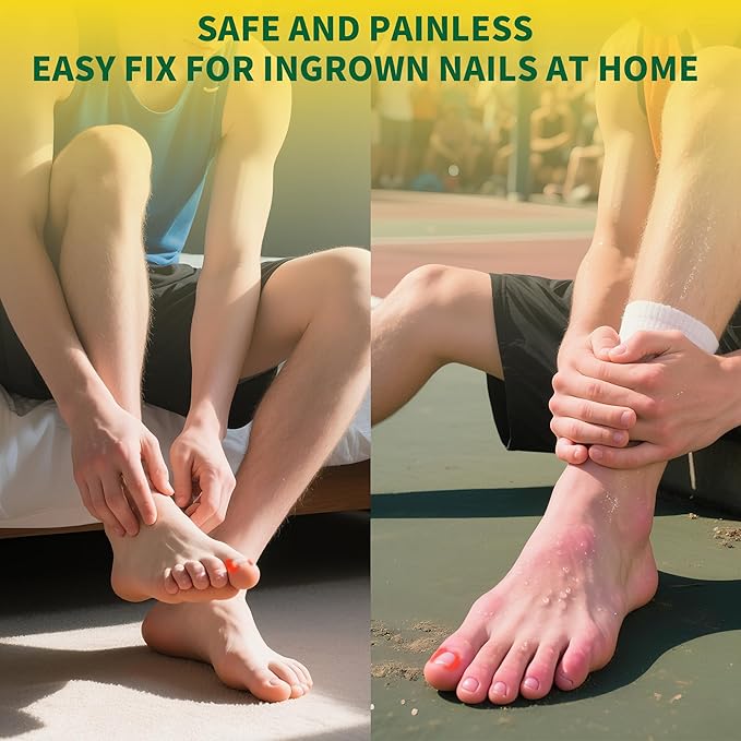 Large Size-Titanium Alloy Ingrown Toenail Treatment & Removal Kit for Quick Relief, Ingrown Toenail Removal Kit竊?Professional Ingrown Toenail Corrector, Ingrown Toenail Tools for Quick Relief, 10 Pcs