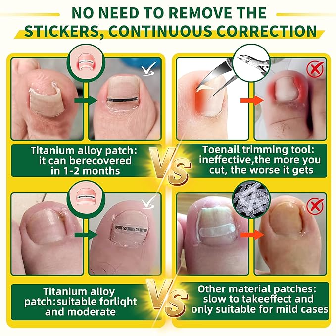 Large Size-Titanium Alloy Ingrown Toenail Treatment & Removal Kit for Quick Relief, Ingrown Toenail Removal Kit竊?Professional Ingrown Toenail Corrector, Ingrown Toenail Tools for Quick Relief, 10 Pcs