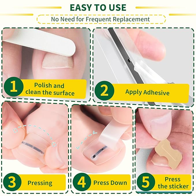 Small Size-Titanium Alloy Ingrown Toenail Treatment & Removal Kit for Quick Relief, Ingrown Toenail Removal Kit竊?Professional Ingrown Toenail Corrector, Ingrown Toenail Tools for Quick Relief, 10 Pcs
